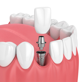 Dental Implants